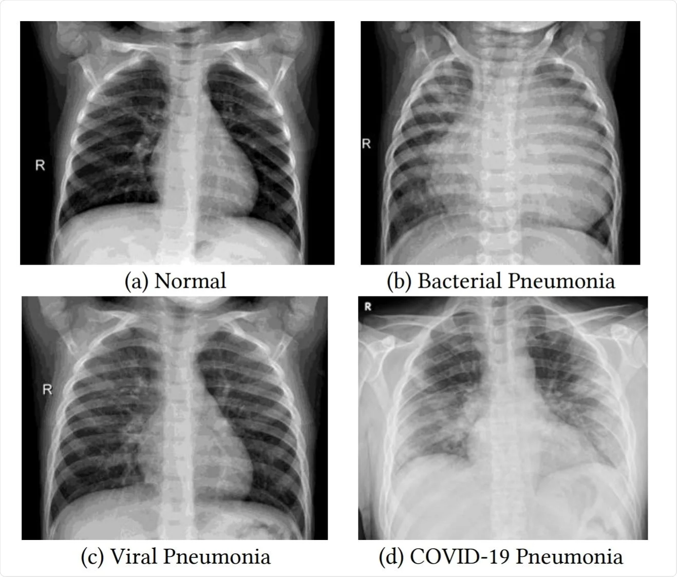 x-ray_chest